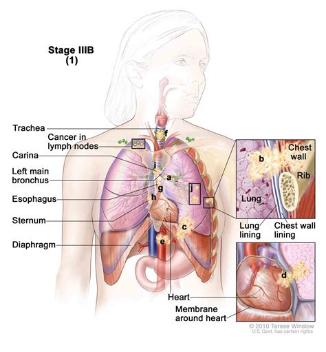 Stage 4 Cancer Lung | MedicineBTG.com