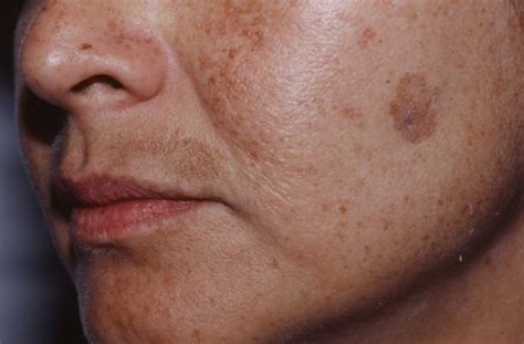 Your Guide to Melasma: How To Treat Tricky Dark Spots - The Pretty Pimple