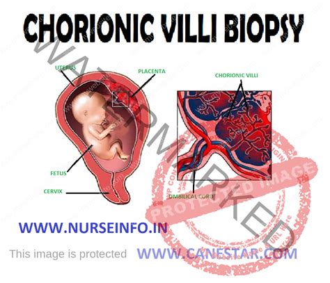 CHORIONIC VILLI BIOPSY - Nurse Info