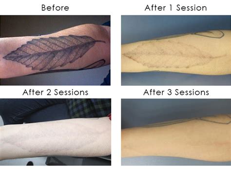 Laser Tattoo Removal: Shining Light on a Flourishing Industry