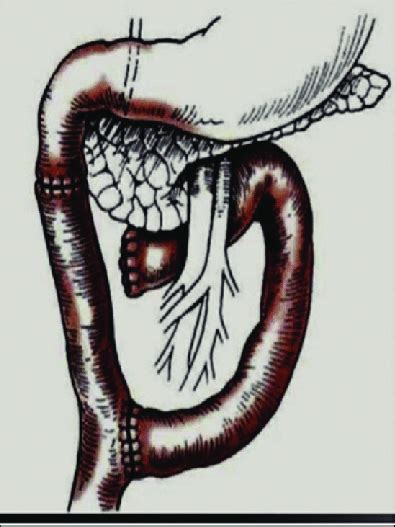 Duodenojejunostomy in Y Roux | Download Scientific Diagram