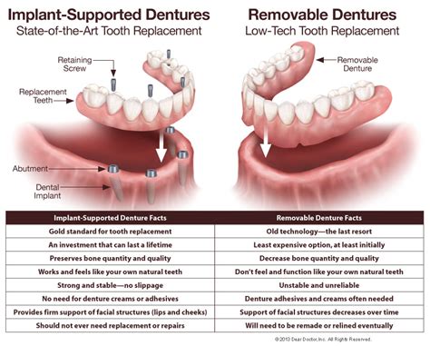 Fixed Dentures | Perfect-A-Smile Dental Group | Chagrin Falls OH