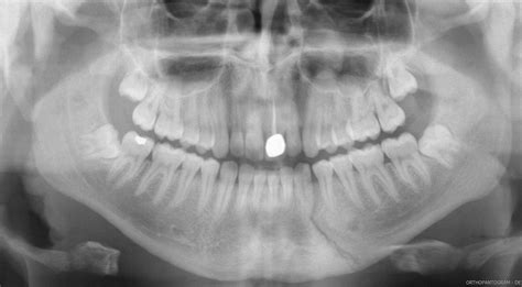 Mandibular Fracture X Ray