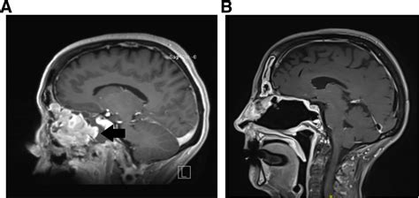 MRI Imaging of the Olfactory Neuroblastoma. Pre (a) and post (b)... | Download Scientific Diagram