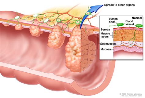 Understanding Colorectal Cancer | Knight Cancer Institute| OHSU