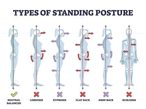 Types of standing postures and medical back pathology set outline ...