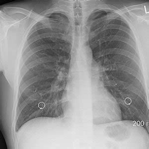 Rib Fracture Diagnosis in the Panscan Era - HealthManagement.org