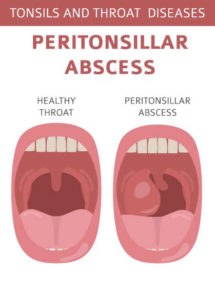 Peritonsillar Abscess Uvula Deviation