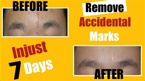 How To Remove Injury Marks On Face At Home | Hand Cut Marks Removal | Accident Marks Remove At ...