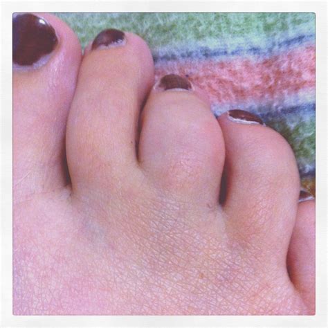 sausage digit (my middle toe) | Middle toe, Toes, Sausage