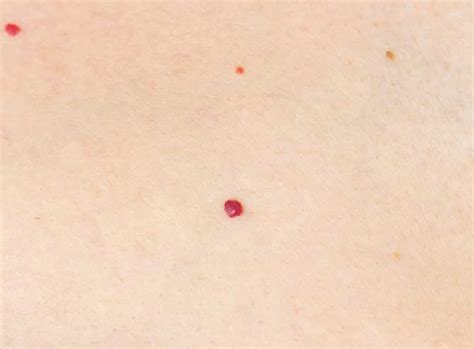 Cherry Angiomas / Red Spots Treatment | Laser Melbourne