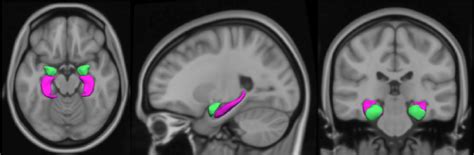 T1-weighted MRI scan (axial, sagittal and coronal view) showing the... | Download Scientific Diagram