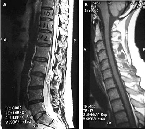 (A) MRI of the lumbar spine in 1998 showing tethered cord with dermoid ...