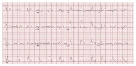 Rudyard Kipling Prevalecer Generador right bundle branch block ecg ...