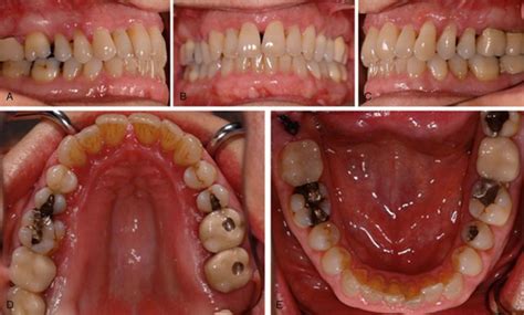 23: Chronic Periodontitis | Pocket Dentistry