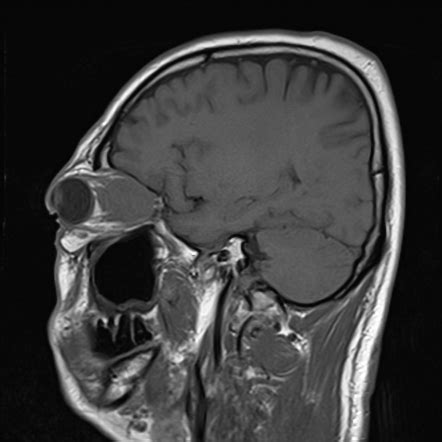 IgG4-related orbital disease mimicking orbital lymphoma | Image | Radiopaedia.org