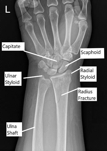 Case Study: Distal Radius Fracture in 55 Year Old Male
