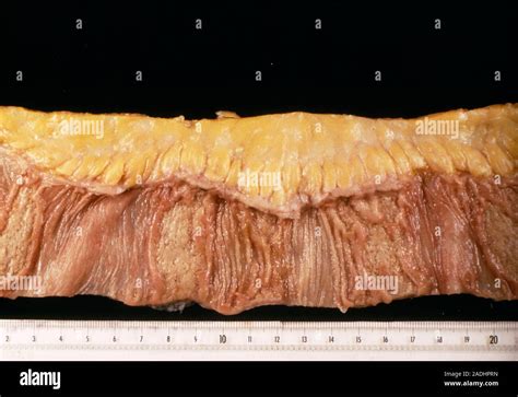 Intestinal tuberculosis. Gross specimen of a piece of an intestine in intestinal tuberculosis ...