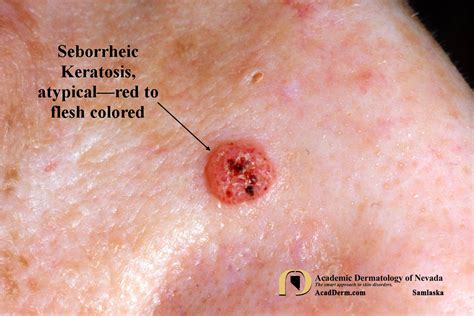 Seborrheic Keratosis: Atypical Forms... - Academic Dermatology of Nevada