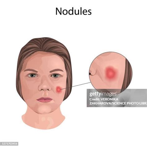 89 Nodules Skin Stock Photos, High-Res Pictures, and Images - Getty Images