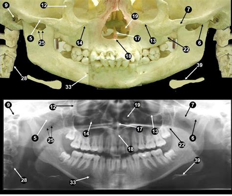 Dentistry lectures for MFDS/MJDF/NBDE/ORE: Anatomical Landmarks Of Panoramic Radiographs ...