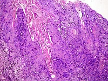 Pathology Outlines - Verrucous