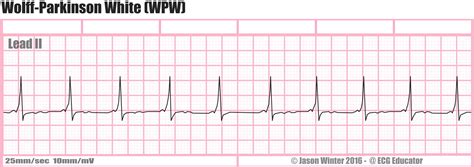 ECG Educator Blog : Wolff-Parkinson-White