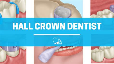 Hall Crown Dentist - Arctic Dental | Muscatine Pediatric Dentistry