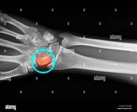 hand x-ray showing a fracture of the navicular or scaphoid bone of the ...