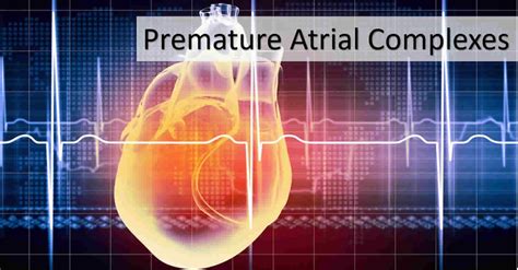 Premature atrial contraction definition, causes, symptoms, diagnosis ...