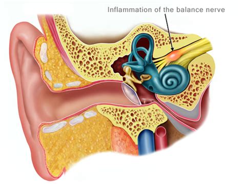 Homeopathic Treatment for Vestibular Neuritis - Homeopathy at DrHomeo.com