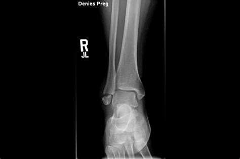 Case Study: Can You Diagnose the Weber Fracture? - Clinical Pain Advisor