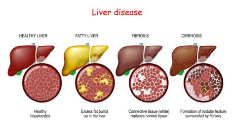 1,200+ Fibrosis An Stock Illustrations, Royalty-Free Vector Graphics ...