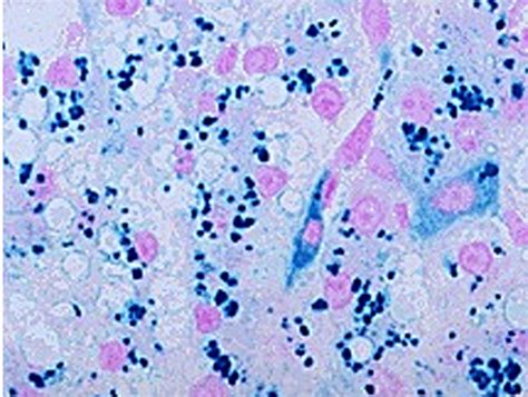 ferritin and hemosiderin MRI - Questions and Answers in MRI