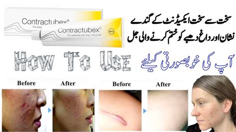 contractubex | contractubex gel | contractubex gel how to use ...