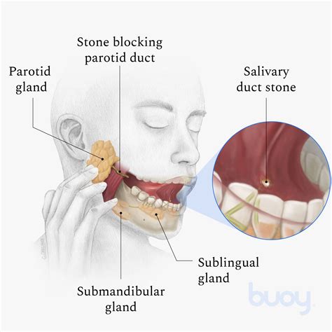 Salivary Stone