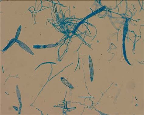 [PDF] Microsporum audouinii tinea capitis in a Swiss school: assessment and management of ...