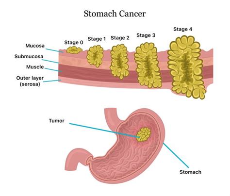 Stomach Cancer | Symptoms, Causes, Stages, Treatment and Survival Rates