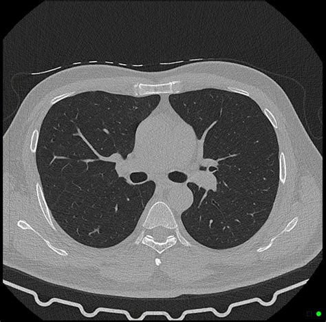 Chest CT Scan - Melbourne Radiology