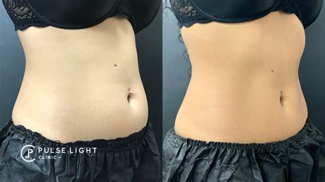 CoolSculpting Fat Freezing Abdomen | Pulse Light Clinic London