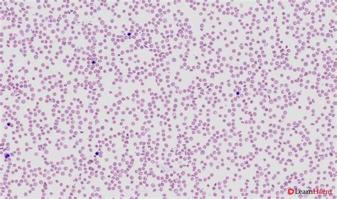 Thalassaemias and Haemoglobinopathies - LearnHaem | Haematology Made Simple