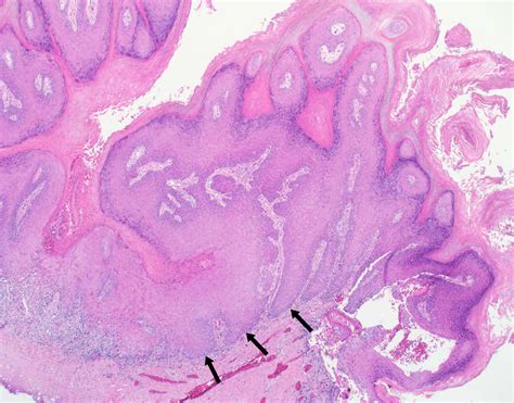 Verrucous Squamous Carcinoma Causing Laryngeal Leukoplakia | Iowa Head and Neck Protocols