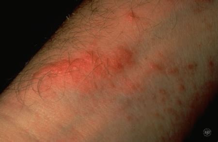 Poison ivy, oak, and sumac: What does the rash look like?