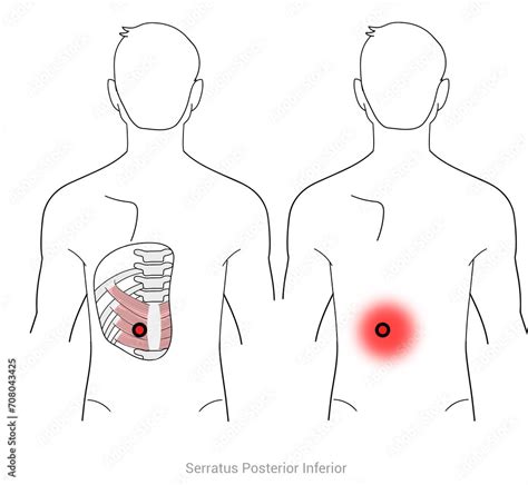 Serratus Posterior Inferior: Myofascial trigger points and associated ...