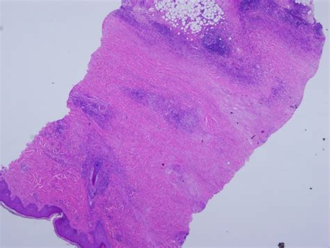 [Figure, Necrobiosis Lipoidica Contributed by Daniel Neelon, MD ...