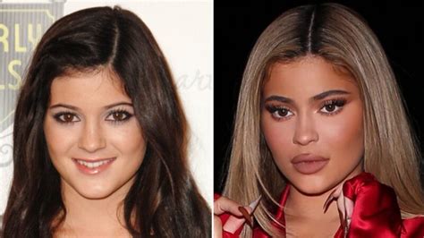 Kylie Jenner Before and After ? All of her Plastic Surgery!