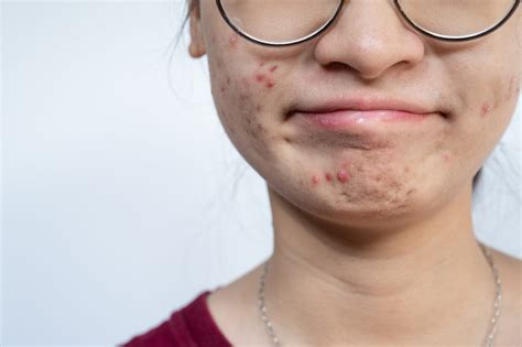 Acne in the Pediatric Population: Prevalence, Emotional Toll, and ...