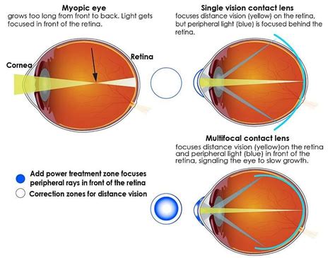 Myopia Management | Ideal EyeCare Ophthalmology