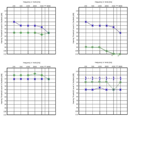 How to Read an Audiogram: The Basics