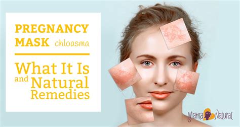 Pregnancy Mask (Chloasma): What It Is & Natural Remedies